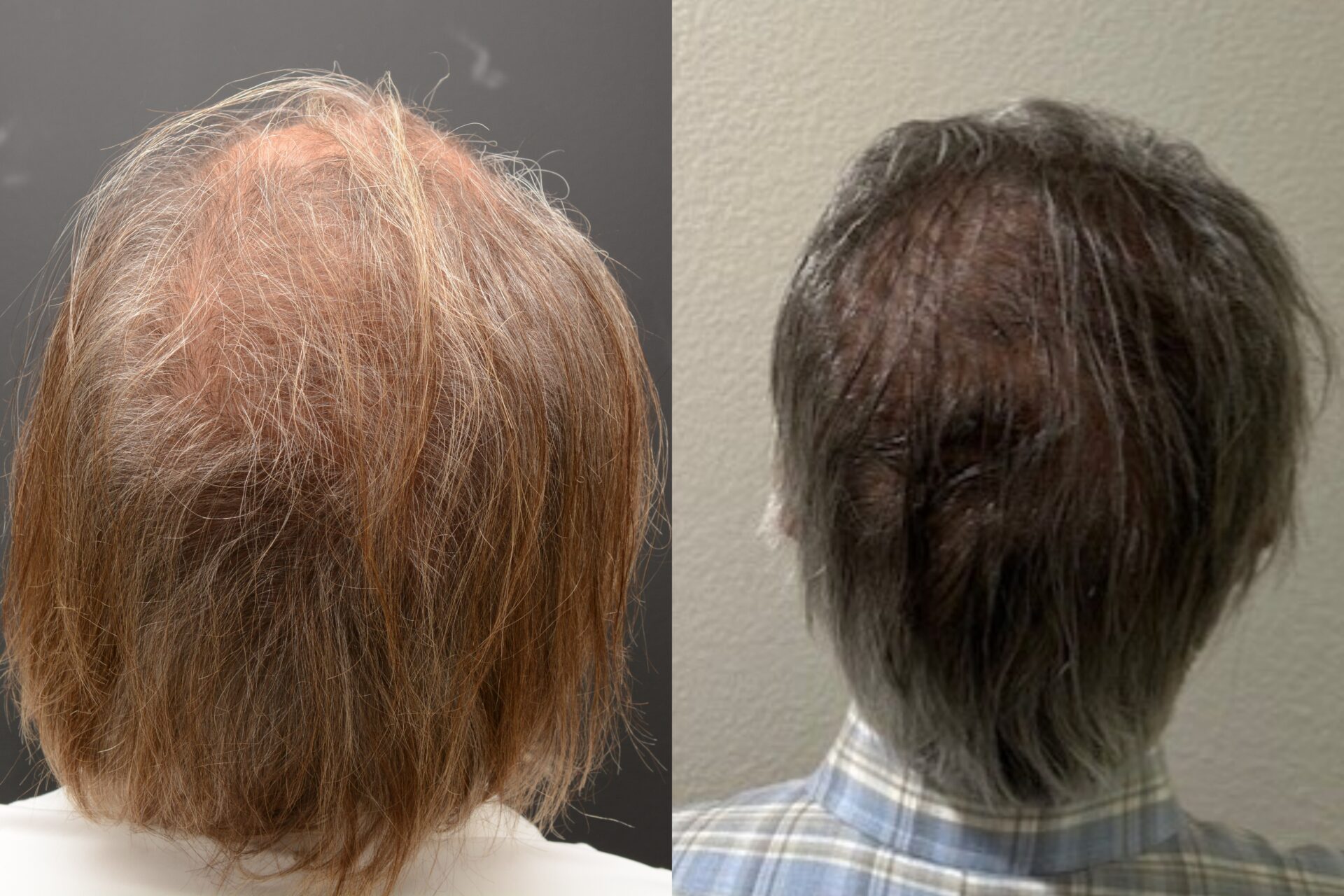 NeoGraft Hair Transplant Newport Beach