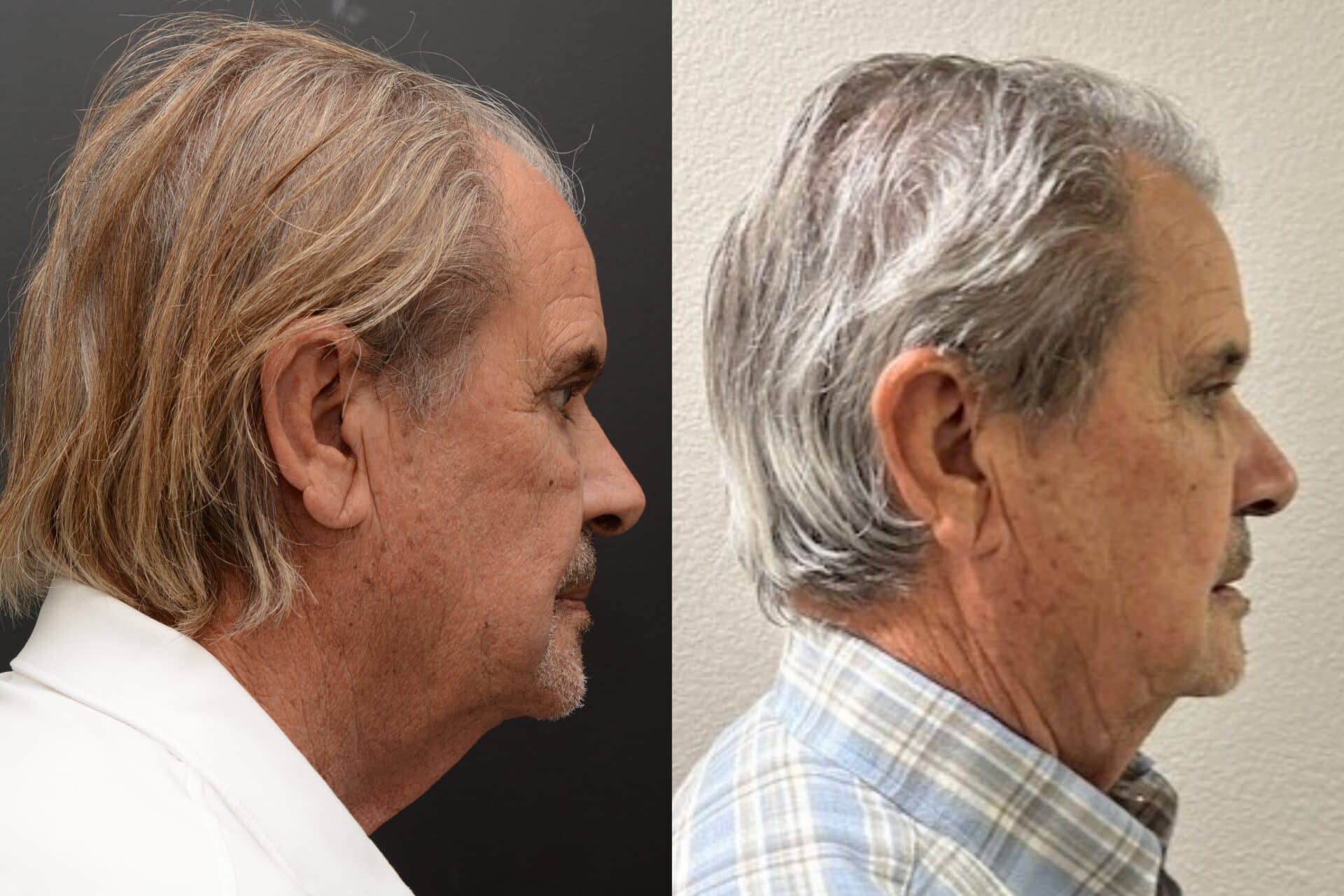 NeoGraft Hair Transplant Newport Beach