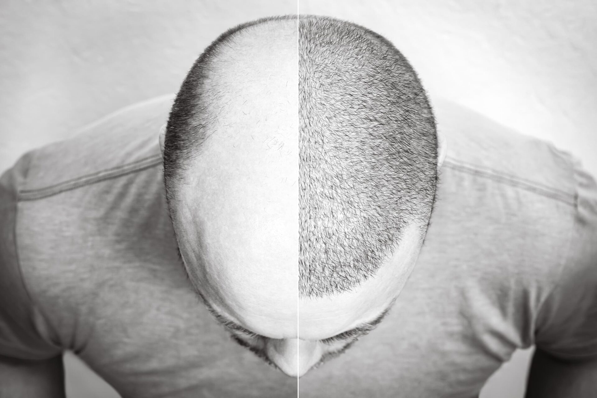 before after hair transplant with NeoGraft-allure-md